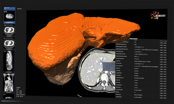 REMOVIRT H3D: Reconstrución e modelado virtual do fígado en 3D