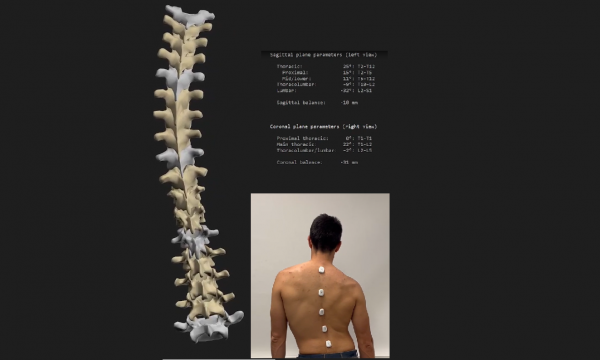 Spine Measure